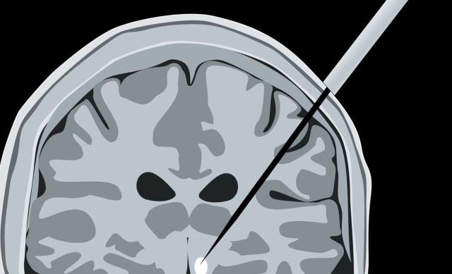 Illustration of gene therapy injection to the brain