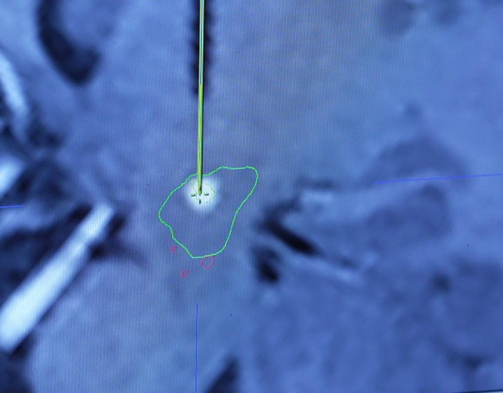 Brain scan during gene therapy injection 